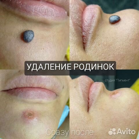 Удaление родинок, папиллом, бородавок