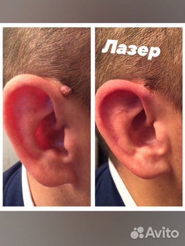 Лазер Папилломы Шрамы Растяжки